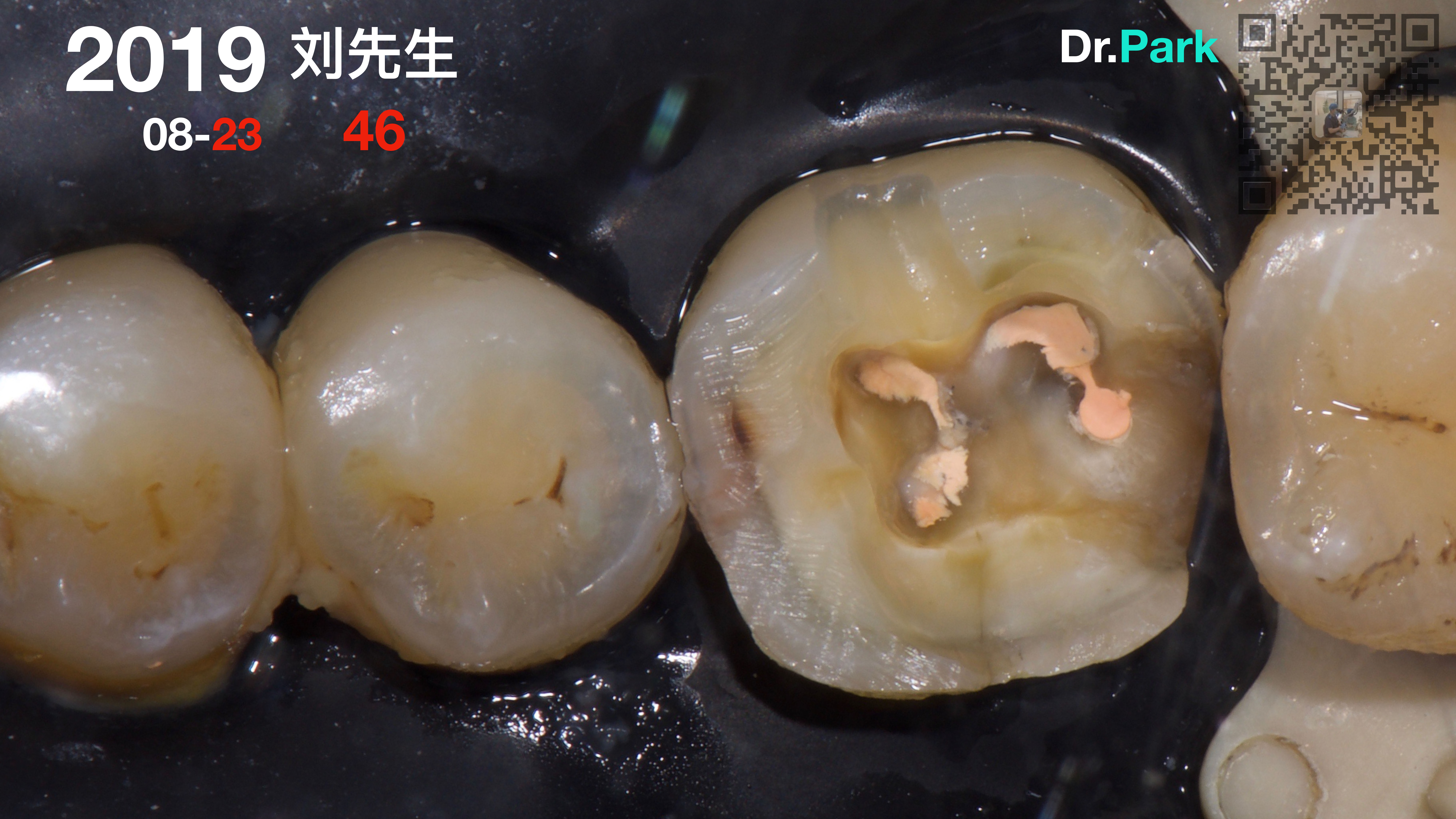 一例前牙外伤后打桩全瓷冠修复